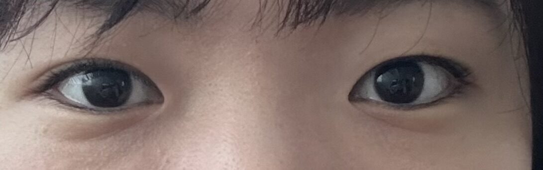 自然癒着+ウィットイム手術後期