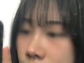 这是我隆鼻手术的反馈
