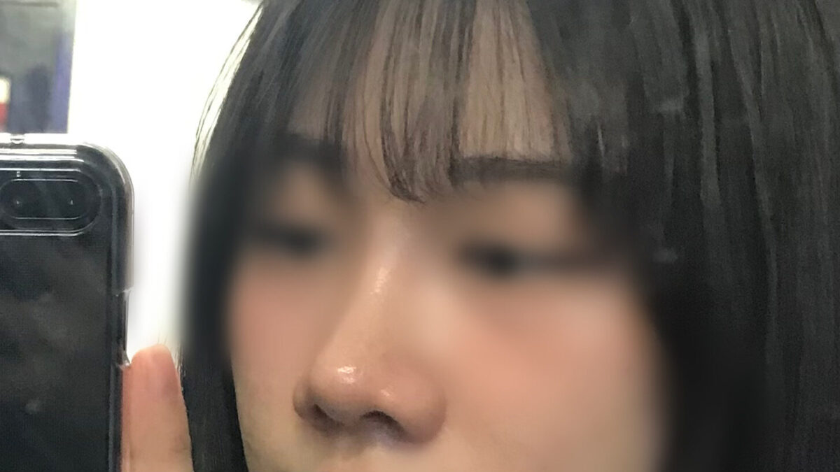 鼻整形の後期です🐽