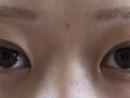 การผ่าตัดแก้ไขสายตาของผู้กำกับโด ออน-รก