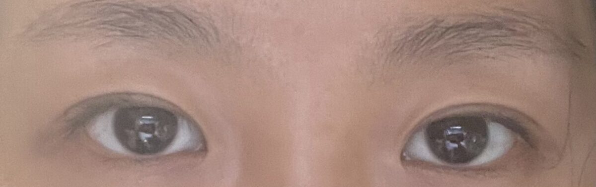 เทคนิคการยกกระชับเปลือกตาบนและแก้ไขเปลือกตาแบบไม่ต้องกรีด โดยผู้กำกับ โด ออน-ร็อก