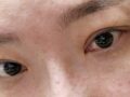 บทวิจารณ์การผ่าตัดแก้ไข โดย ดร. คิม ฮงจิน