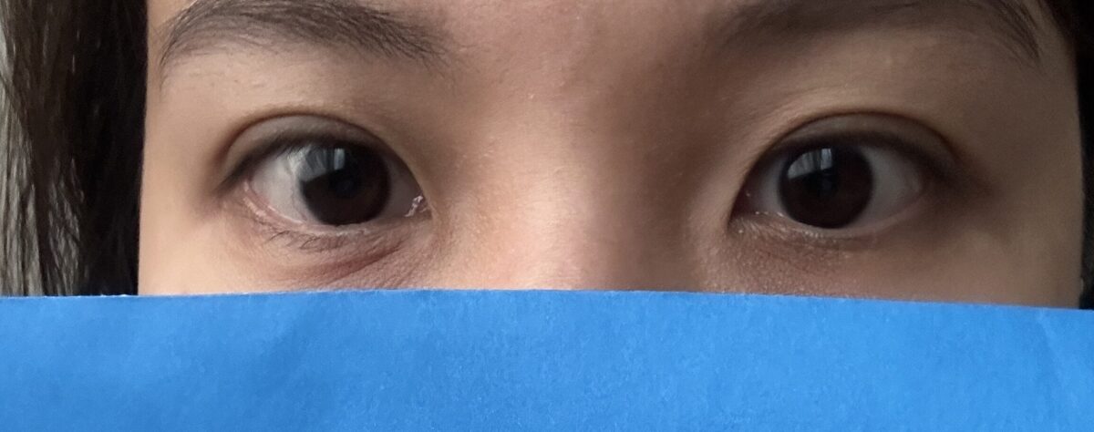 รีวิวหลังการผ่าตัดทำตาสองชั้นแบบซ่อนไหมเย็บโดยใช้เทคนิคการยึดเกาะตามธรรมชาติ 2 เดือน (โดย ดร. คิม ฮงจิน)