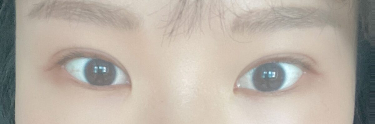 ฉันเข้ารับการผ่าตัดแก้ไขสายตาโดยผู้กำกับคิม ฮงจิน