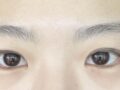 รีวิวการผ่าตัดทำตาสองชั้นของ ดร. คิม ฮงจิน: 2 เดือนต่อมา