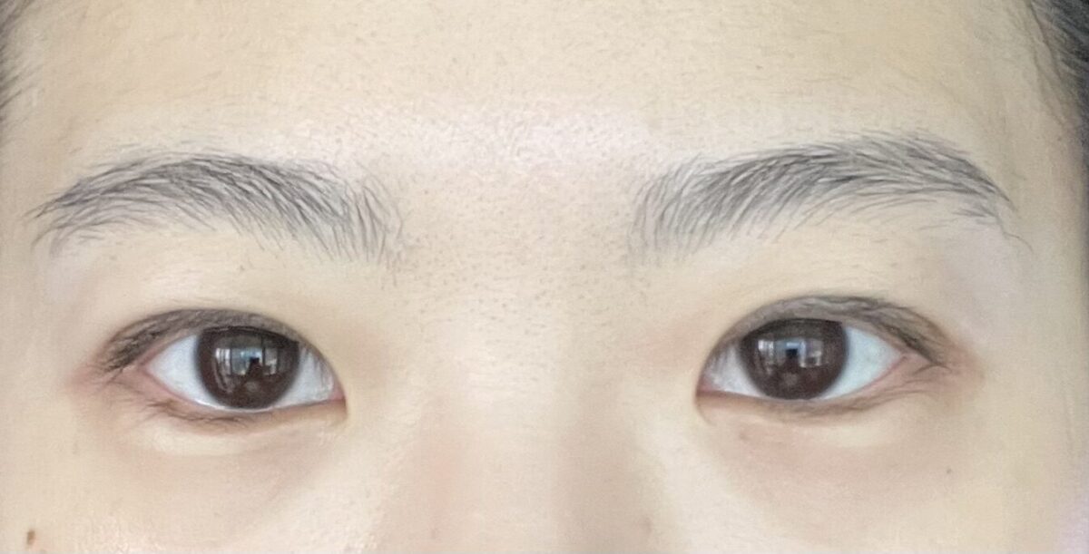 รีวิวการผ่าตัดทำตาสองชั้นของ ดร. คิม ฮงจิน: 2 เดือนต่อมา