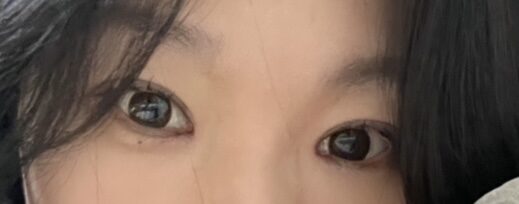 การผ่าตัดแก้ไขเปลือกตา, การกรีดเปลือกตา, การผ่าตัดตกแต่งหัวตา, ศัลยกรรมเปลือกตาบน โดยผู้กำกับ โด ออน-ร็อก
