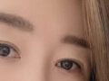 รีวิวหลังการผ่าตัดแก้ไขหนังตาสองชั้น 1 เดือน