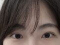 ฉันเข้ารับการผ่าตัดทำตาสองชั้นกับคุณหมอคิม ฮงจินค่ะ
