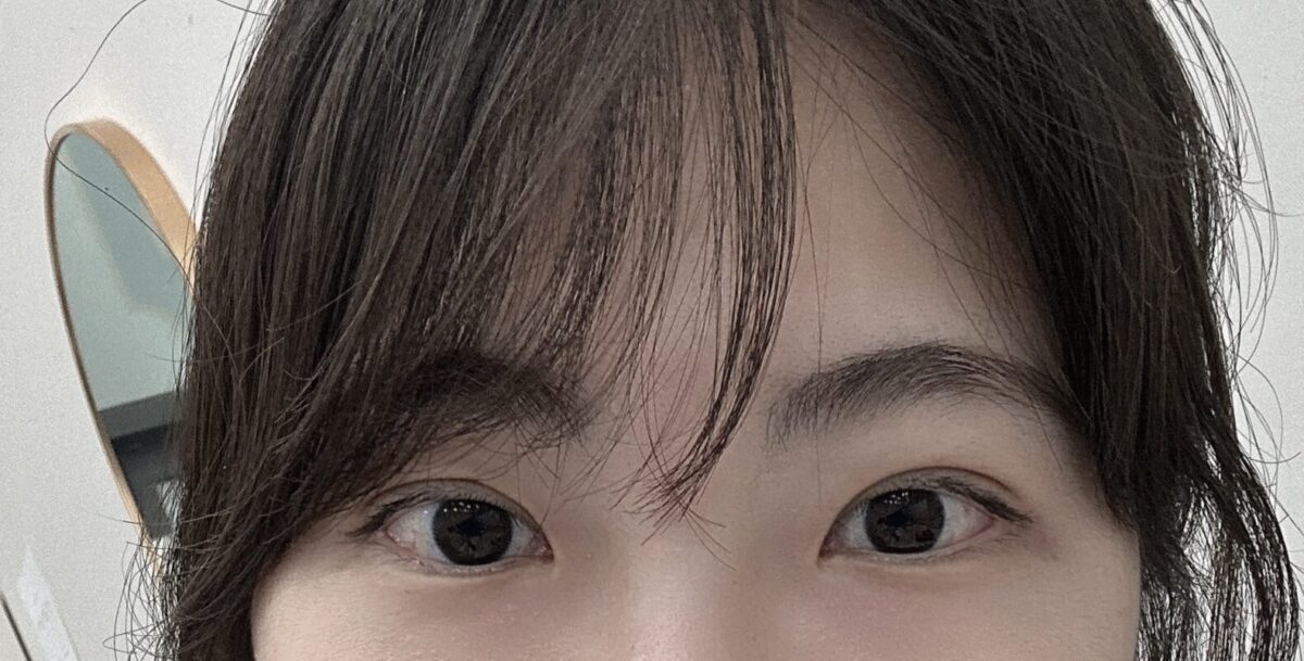 ฉันเข้ารับการผ่าตัดทำตาสองชั้นกับคุณหมอคิม ฮงจินค่ะ