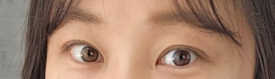 ฉันเข้ารับการผ่าตัดแก้ไขหนังตาสองชั้นกับคุณหมอคิม ฮงจินค่ะ