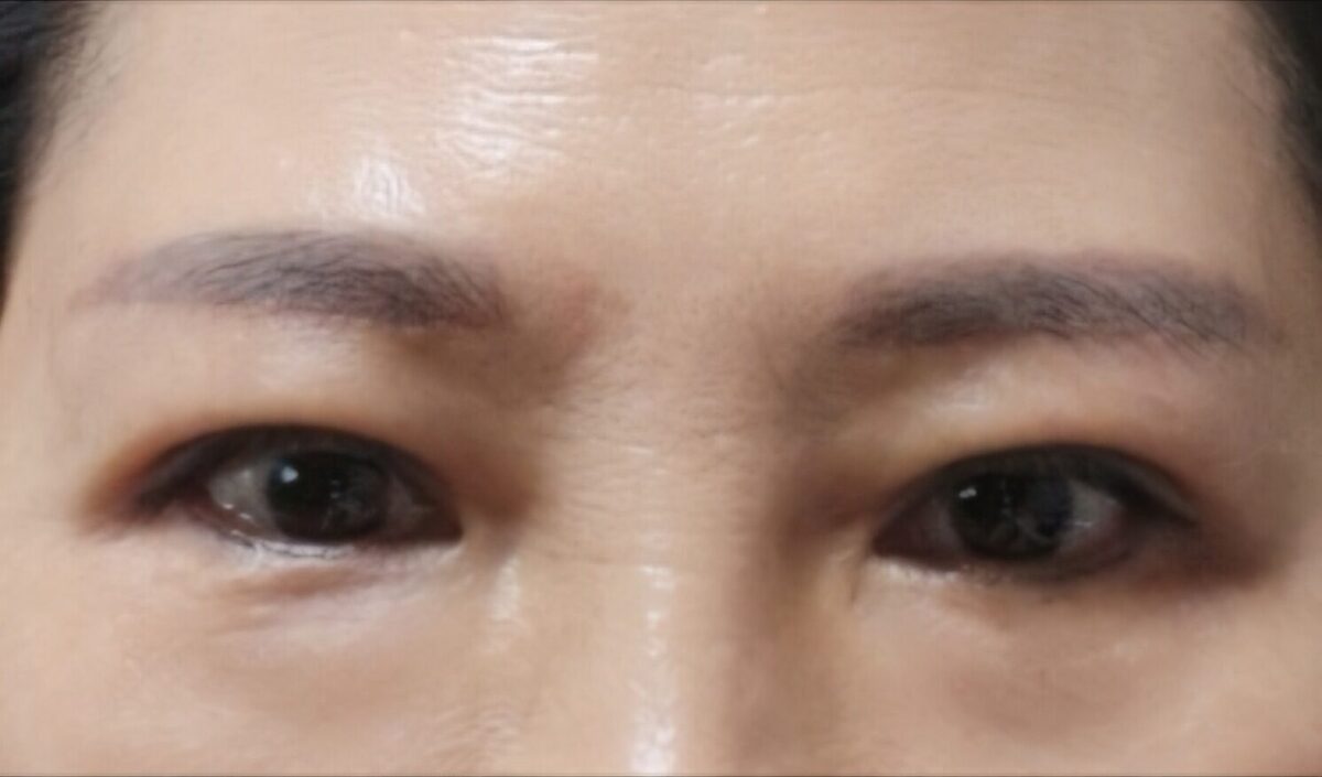 眉毛巨像+埋没二重まぶた手術後期（キム・ホンジン院長）
