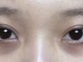 双眼皮手术+眼下脂肪重排