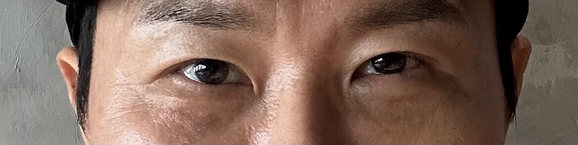 การปลูกถ่ายไขมันใต้ตาและการผ่าตัดทำตาสองชั้น โดย ดร.คิม ฮงจิน