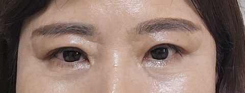 目のペアカップル手術
