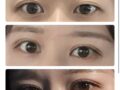 การผ่าตัดตาของผู้กำกับโด ออน-ร็อก (แบบไม่กรีดแผล)