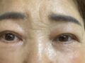 金洪振院长   埋线双眼皮+切眉+上眼睑  术后反馈