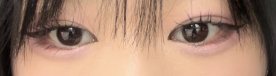 ศัลยกรรมตกแต่งเปลือกตาสองชั้น