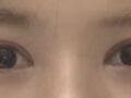 รีวิวการผ่าตัดแก้ไขตาสองชั้น