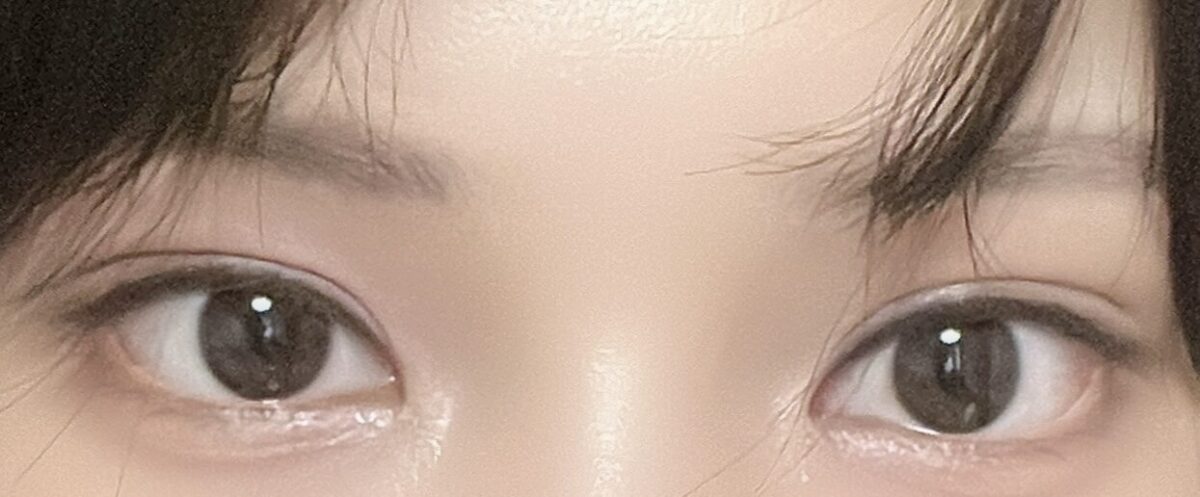 自然癒着法