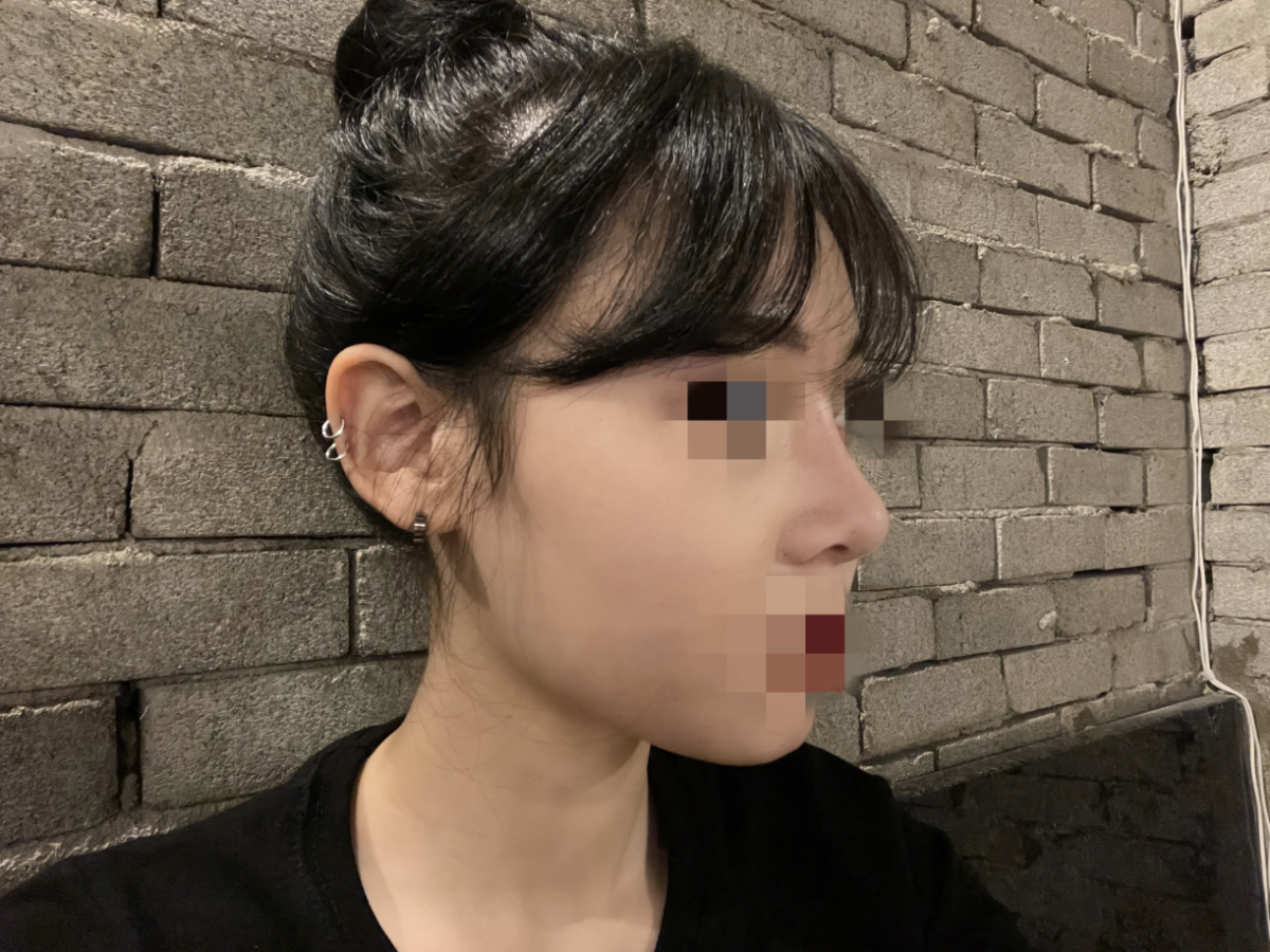 隆鼻手术太疯狂了！！