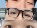 道言録院長 - 非切開目矯正後期（男）