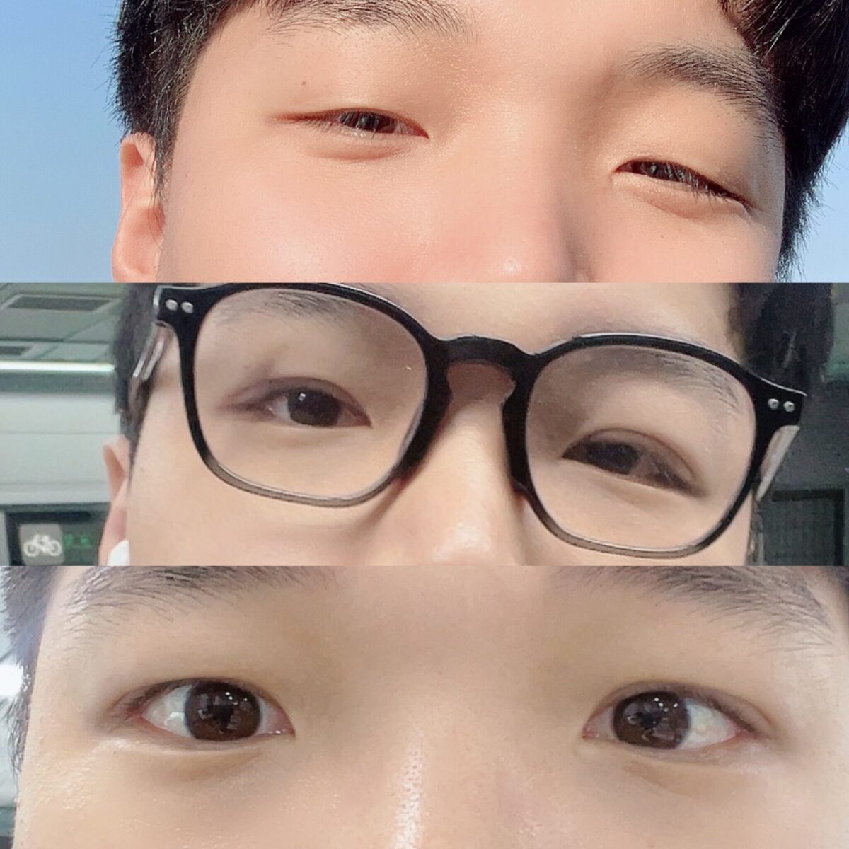 道言録院長 - 非切開目矯正後期（男）