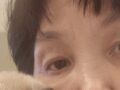 การกระจายตัวของไขมันเหนือตา