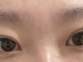 บทวิจารณ์การผ่าตัดทำตาสองชั้นแบบกรีด โดยผู้อำนวยการ โด ออน-ร็อก ที่คลินิกอิลมิริ