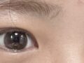 都彦禄 + 双眼皮埋线（修复）