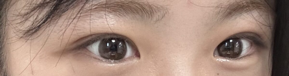 都彦禄 + 双眼皮埋线（修复）
