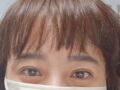 การแก้ไขเปลือกตาโดยไม่ต้องผ่าตัด
