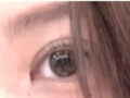 都彦禄医生主刀的修复手术（自然粘合+上眼角）