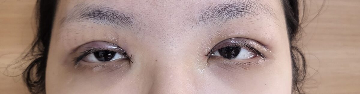 รีวิวการผ่าตัดทำตาสองชั้น