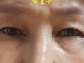 双眼皮 术后反馈