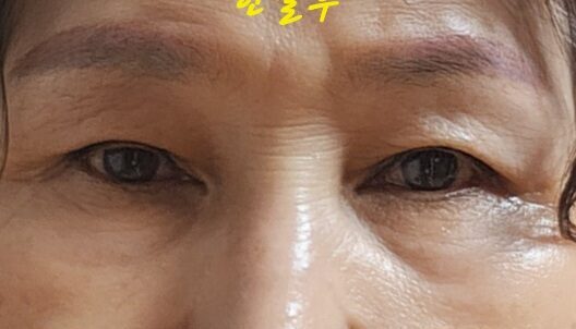 双眼皮 术后反馈