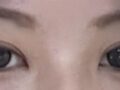 都彦禄医生双眼皮手术 + 上眼角手术