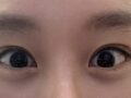 Đánh giá phẫu thuật tạo mí mắt đôi bằng phương pháp rạch (Đạo diễn Do Eon-rok)