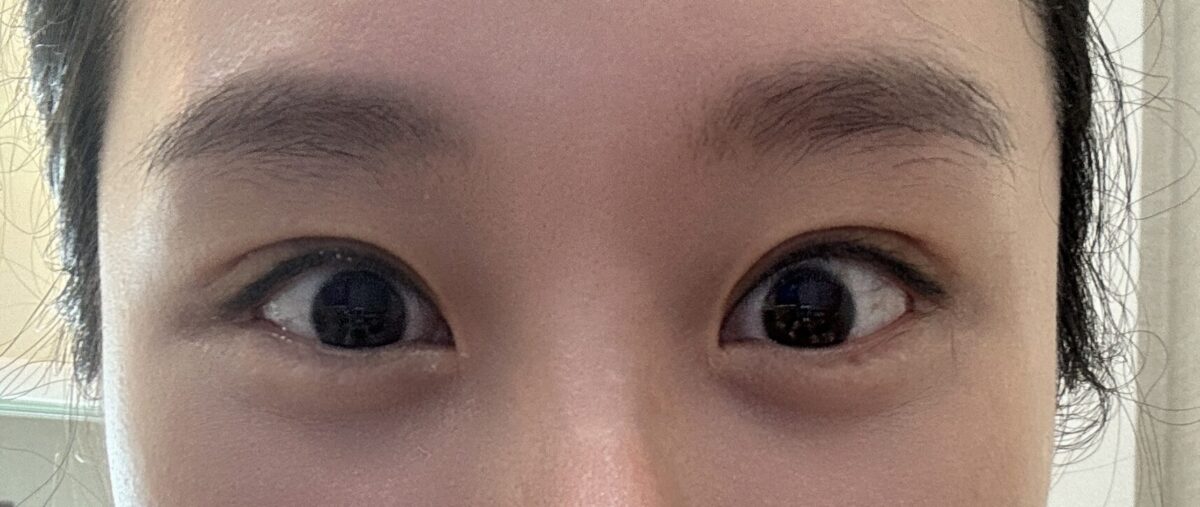 全切双眼皮  术后反馈（都彦禄院长）