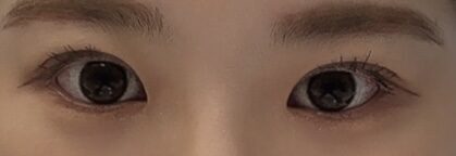 การผ่าตัดแก้ไขสายตาของผู้อำนวยการโด