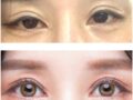 การผ่าตัดแก้ไขตาครั้งที่สี่