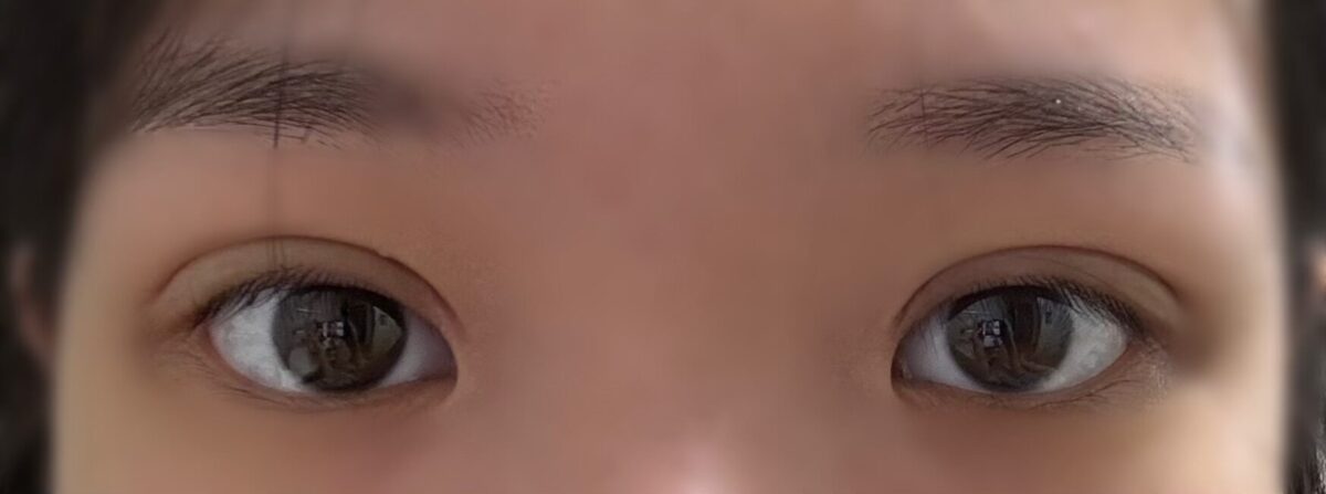 二重まぶた再手術のレビュー