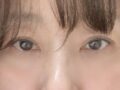 การปลูกถ่ายไขมันบริเวณเปลือกตาบนและใต้ตาของผู้กำกับโด ออน-รก~ 🩷💖