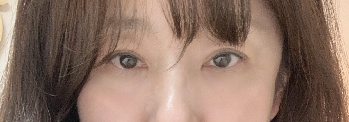 การปลูกถ่ายไขมันบริเวณเปลือกตาบนและใต้ตาของผู้กำกับโด ออน-รก~ 🩷💖