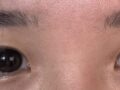 รีวิวการเย็บแผลซ่อนเร้นและการแก้ไขเปลือกตาโดย ดร.คิม ฮงจิน