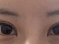 รีวิวการผ่าตัดแก้ไขสายตาของ ดร.โด ออน-รก