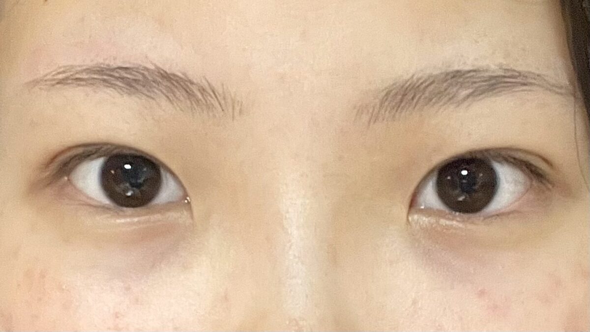 รีวิวการยกกระชับเปลือกตาบนด้วยวิธีธรรมชาติโดย ดร. คิม ฮงจิน !!!