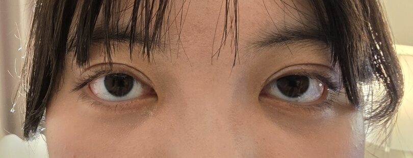 1 เดือนหลังผ่าตัดทำตาสองชั้น