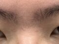 รีวิวการแก้ไขรูปทรงดวงตาผู้ชายโดย ดร.คิม ฮงจิน