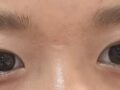 ศัลยกรรมตกแต่งตาสองชั้น (เย็บซ่อนไหม)